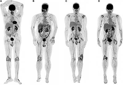 18F-FDG PET molecular imaging: A relevant tool to investigate chronic inflammatory rheumatisms in clinical practice?